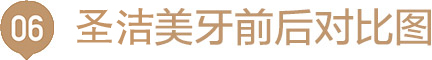 圣洁精品美牙系统优势