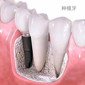 德国精密种植牙:成功实现无痛种牙