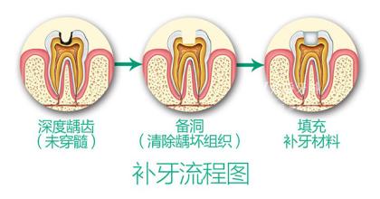 牙齿外伤折断怎么办?