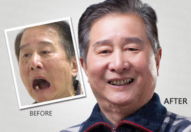 1个半小时种7颗牙 术后2小时啃鸡肉